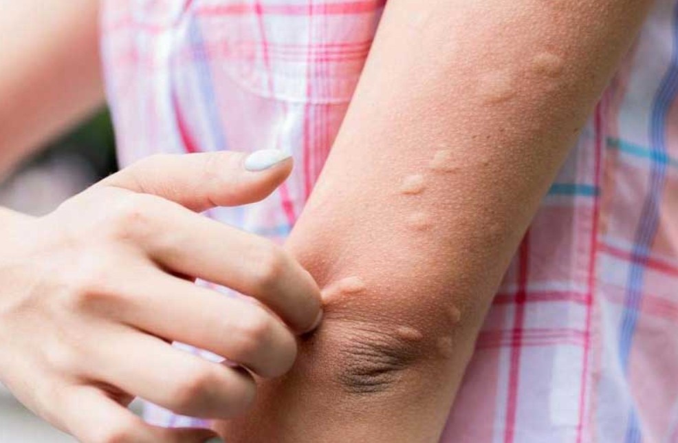 मेचीनगरका दुई महिलामा जापानिज इन्सेफलाइटिस सङ्क्रमण पुष्टि