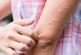 मेचीनगरका दुई महिलामा जापानिज इन्सेफलाइटिस सङ्क्रमण पुष्टि